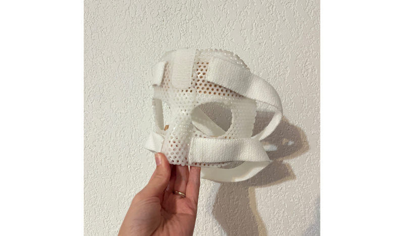 Orthèse faciale thermoformée sur mesure pour fracture du nez